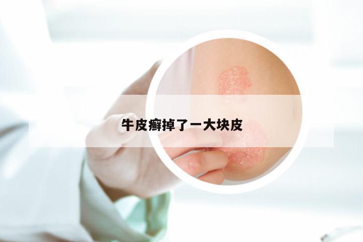 牛皮癣掉了一大块皮