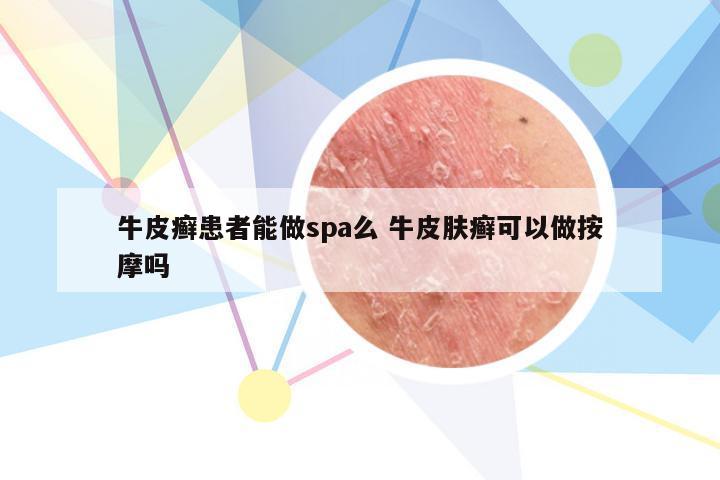 牛皮癣患者能做spa么 牛皮肤癣可以做按摩吗