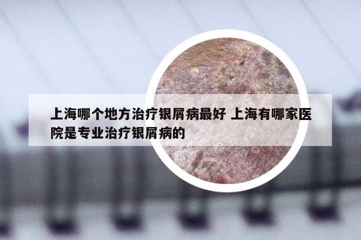上海哪个地方治疗银屑病最好 上海有哪家医院是专业治疗银屑病的