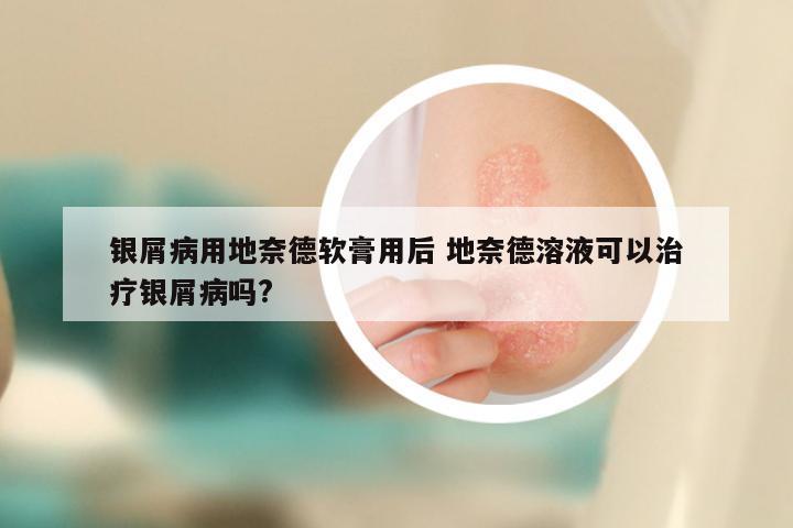 银屑病用地奈德软膏用后 地奈德溶液可以治疗银屑病吗?