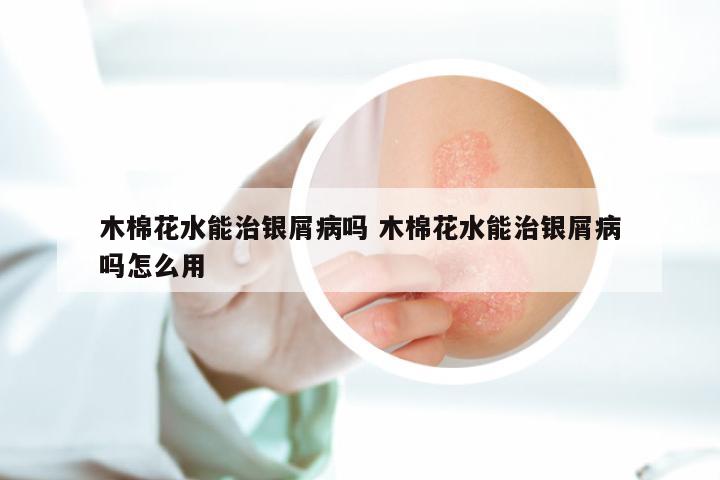 木棉花水能治银屑病吗 木棉花水能治银屑病吗怎么用