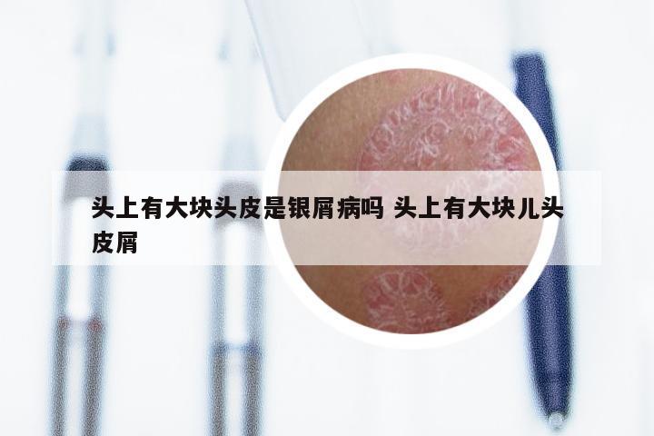 头上有大块头皮是银屑病吗 头上有大块儿头皮屑