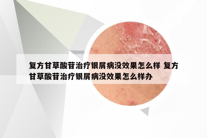 复方甘草酸苷治疗银屑病没效果怎么样 复方甘草酸苷治疗银屑病没效果怎么样办