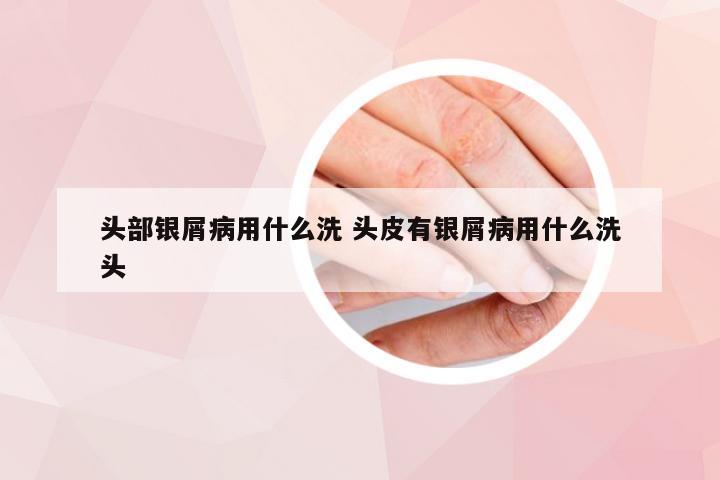 头部银屑病用什么洗 头皮有银屑病用什么洗头