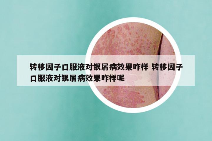 转移因子口服液对银屑病效果咋样 转移因子口服液对银屑病效果咋样呢