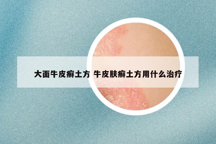 大面牛皮癣土方 牛皮肤癣土方用什么治疗