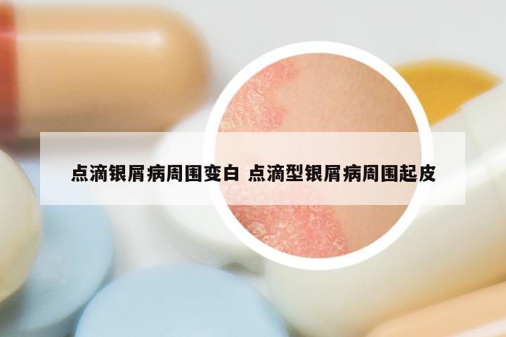 点滴银屑病周围变白 点滴型银屑病周围起皮