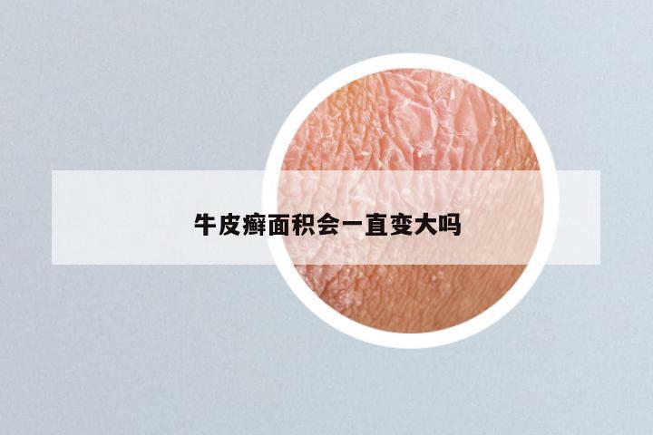 牛皮癣面积会一直变大吗