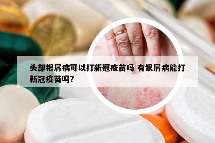 头部银屑病可以打新冠疫苗吗 有银屑病能打新冠疫苗吗?