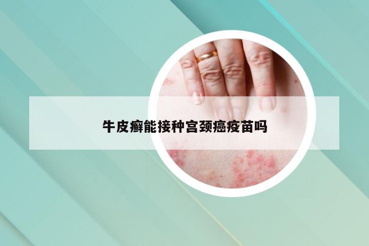 牛皮癣能接种宫颈癌疫苗吗