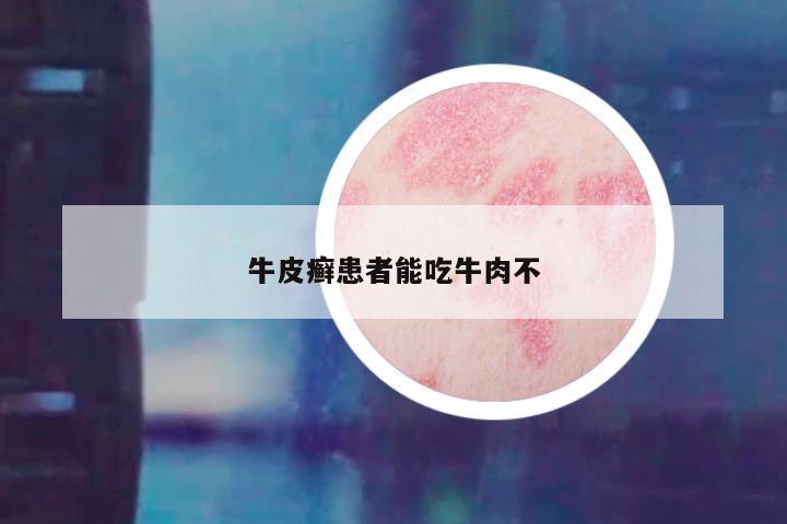 牛皮癣患者能吃牛肉不