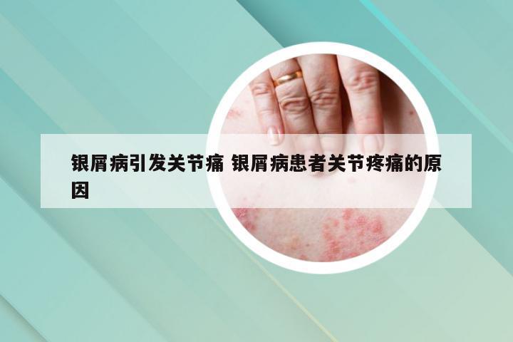 银屑病引发关节痛 银屑病患者关节疼痛的原因