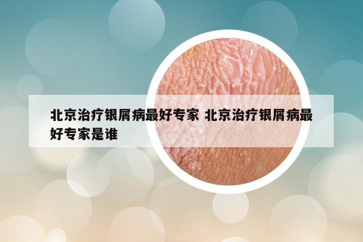 北京治疗银屑病最好专家 北京治疗银屑病最好专家是谁