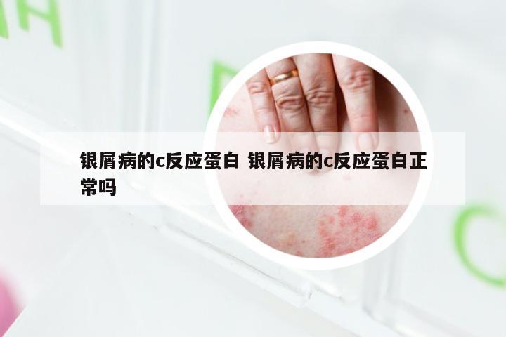 银屑病的c反应蛋白 银屑病的c反应蛋白正常吗