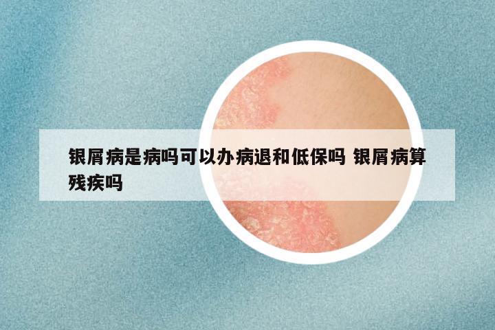 银屑病是病吗可以办病退和低保吗 银屑病算残疾吗