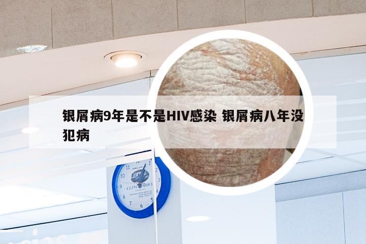 银屑病9年是不是HIV感染 银屑病八年没犯病