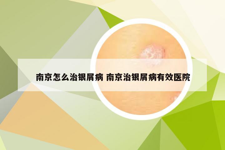 南京怎么治银屑病 南京治银屑病有效医院
