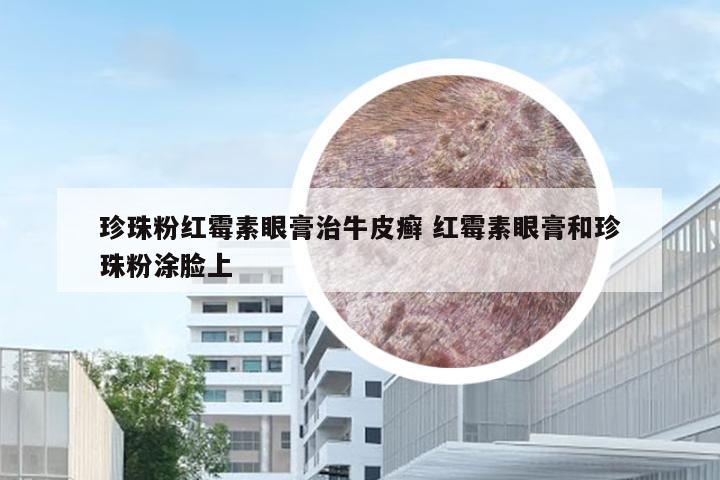 珍珠粉红霉素眼膏治牛皮癣 红霉素眼膏和珍珠粉涂脸上