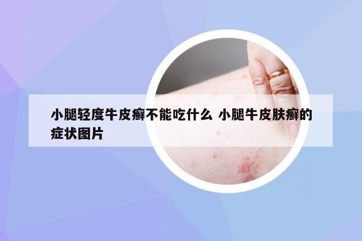 小腿轻度牛皮癣不能吃什么 小腿牛皮肤癣的症状图片