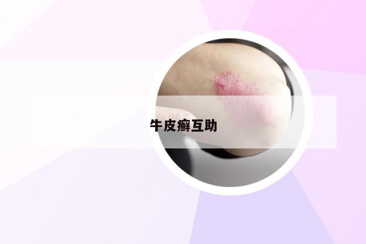 牛皮癣互助