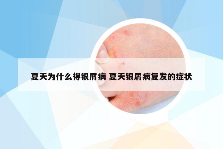 夏天为什么得银屑病 夏天银屑病复发的症状