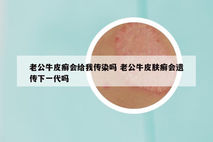 老公牛皮癣会给我传染吗 老公牛皮肤癣会遗传下一代吗