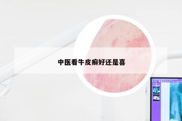 中医看牛皮癣好还是喜