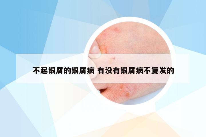 不起银屑的银屑病 有没有银屑病不复发的