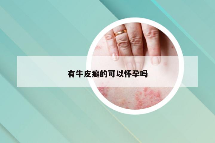 有牛皮癣的可以怀孕吗