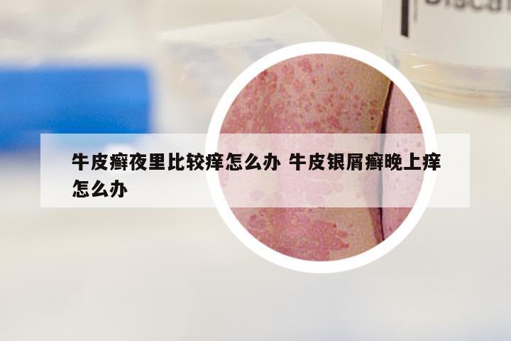 牛皮癣夜里比较痒怎么办 牛皮银屑癣晚上痒怎么办
