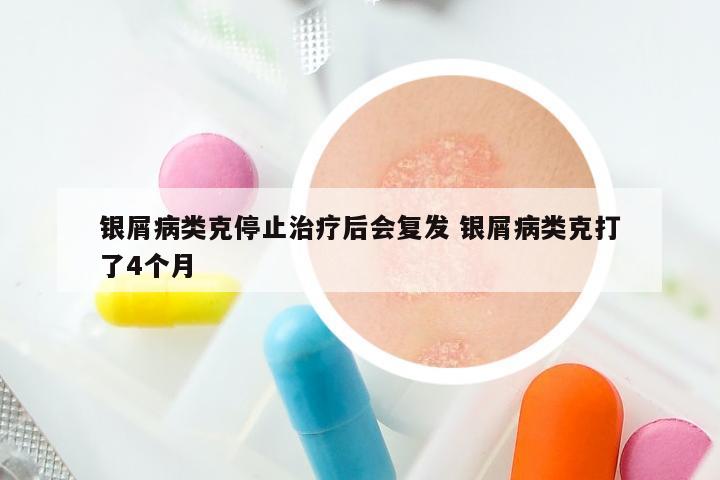 银屑病类克停止治疗后会复发 银屑病类克打了4个月