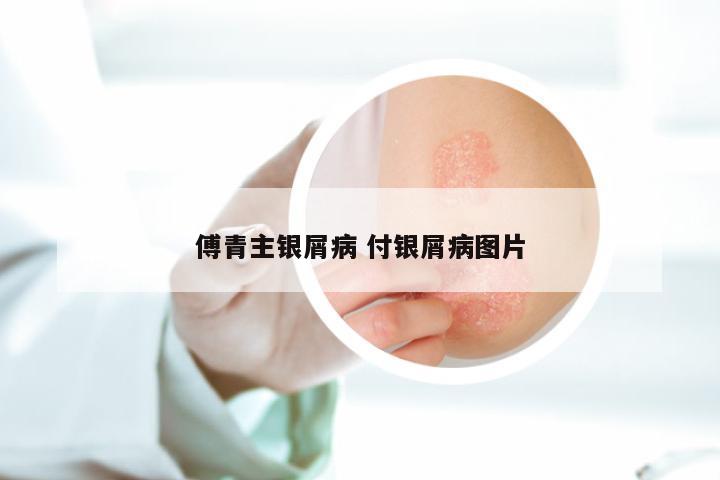 傅青主银屑病 付银屑病图片
