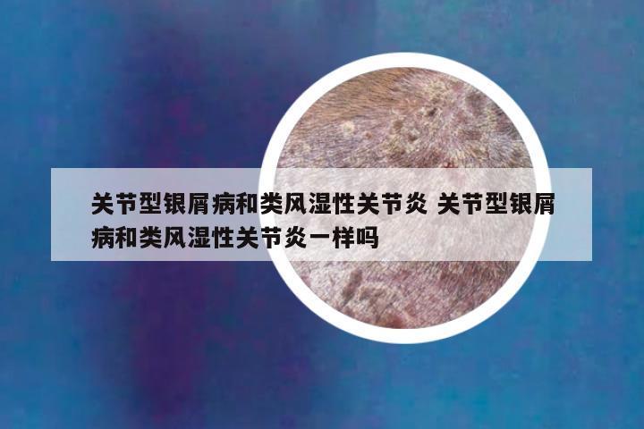 关节型银屑病和类风湿性关节炎 关节型银屑病和类风湿性关节炎一样吗