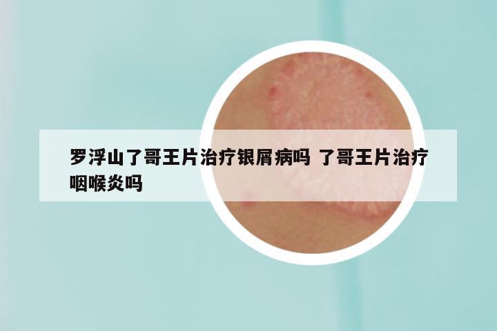 罗浮山了哥王片治疗银屑病吗 了哥王片治疗咽喉炎吗