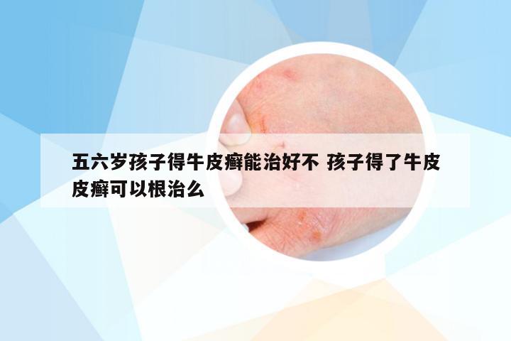 五六岁孩子得牛皮癣能治好不 孩子得了牛皮皮癣可以根治么