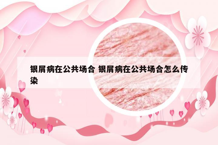 银屑病在公共场合 银屑病在公共场合怎么传染