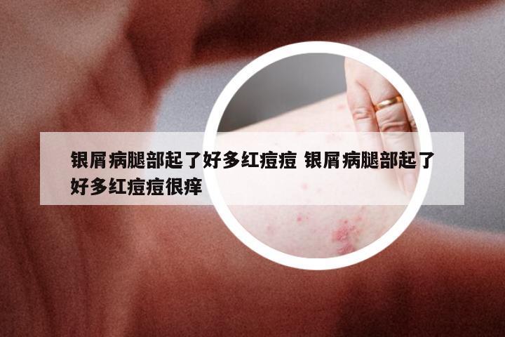 银屑病腿部起了好多红痘痘 银屑病腿部起了好多红痘痘很痒