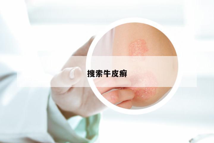 搜索牛皮癣