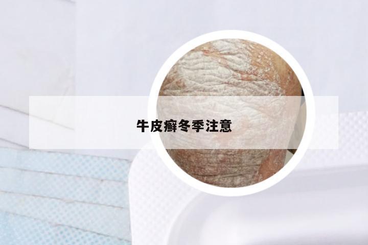 牛皮癣冬季注意
