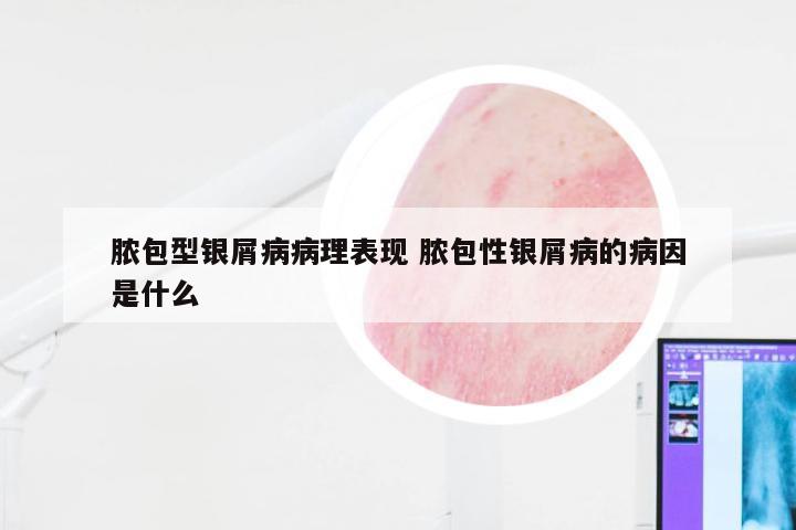 脓包型银屑病病理表现 脓包性银屑病的病因是什么