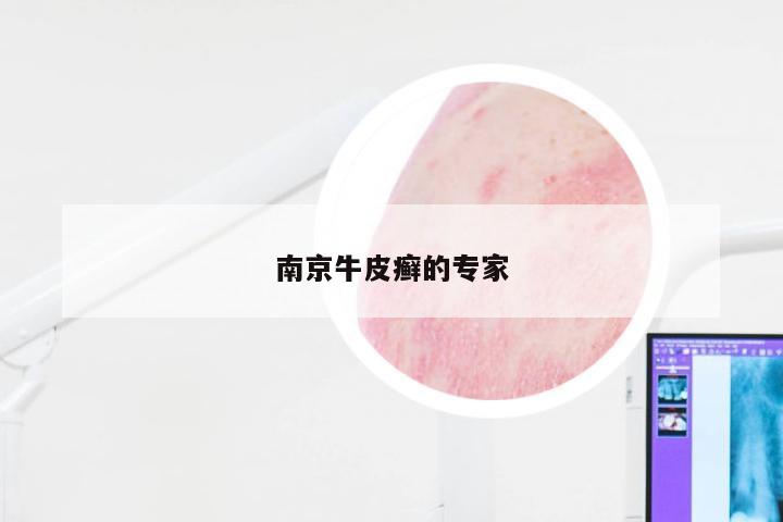 南京牛皮癣的专家