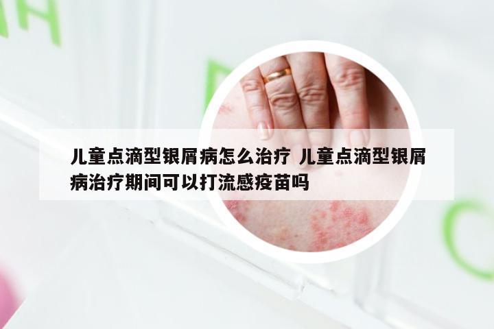 儿童点滴型银屑病怎么治疗 儿童点滴型银屑病治疗期间可以打流感疫苗吗
