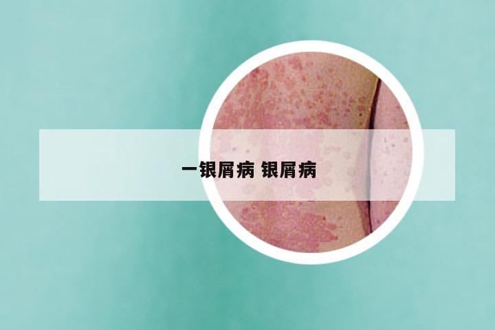 一银屑病 银屑病
