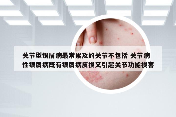 关节型银屑病最常累及的关节不包括 关节病性银屑病既有银屑病皮损又引起关节功能损害
