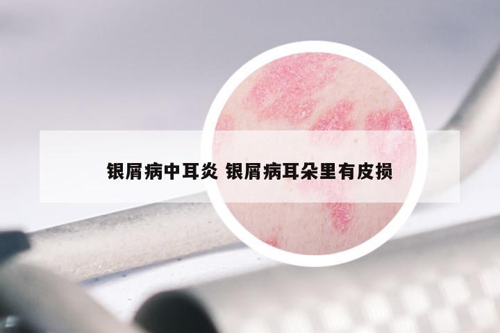 银屑病中耳炎 银屑病耳朵里有皮损
