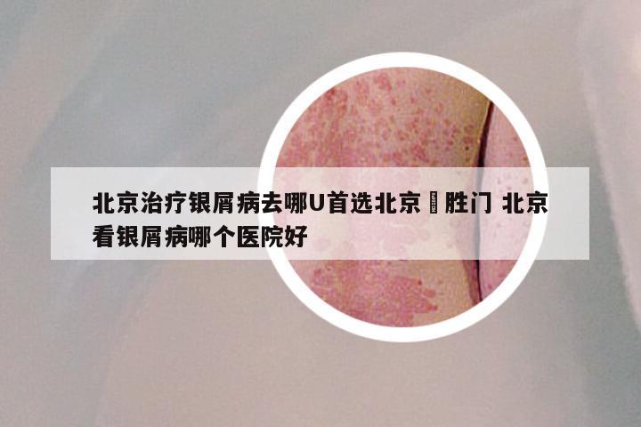 北京治疗银屑病去哪U首选北京徳胜门 北京看银屑病哪个医院好