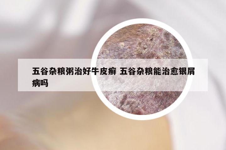 五谷杂粮粥治好牛皮癣 五谷杂粮能治愈银屑病吗