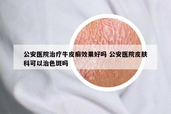 公安医院治疗牛皮癣效果好吗 公安医院皮肤科可以治色斑吗