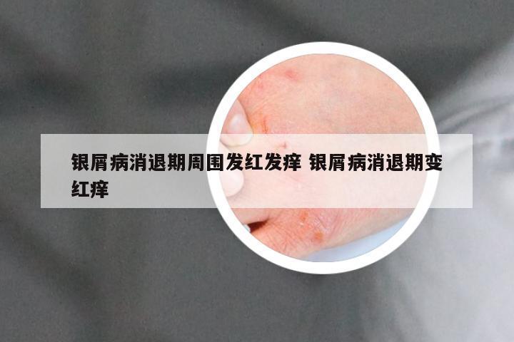 银屑病消退期周围发红发痒 银屑病消退期变红痒