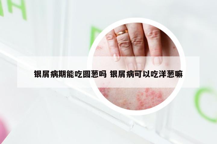 银屑病期能吃圆葱吗 银屑病可以吃洋葱嘛